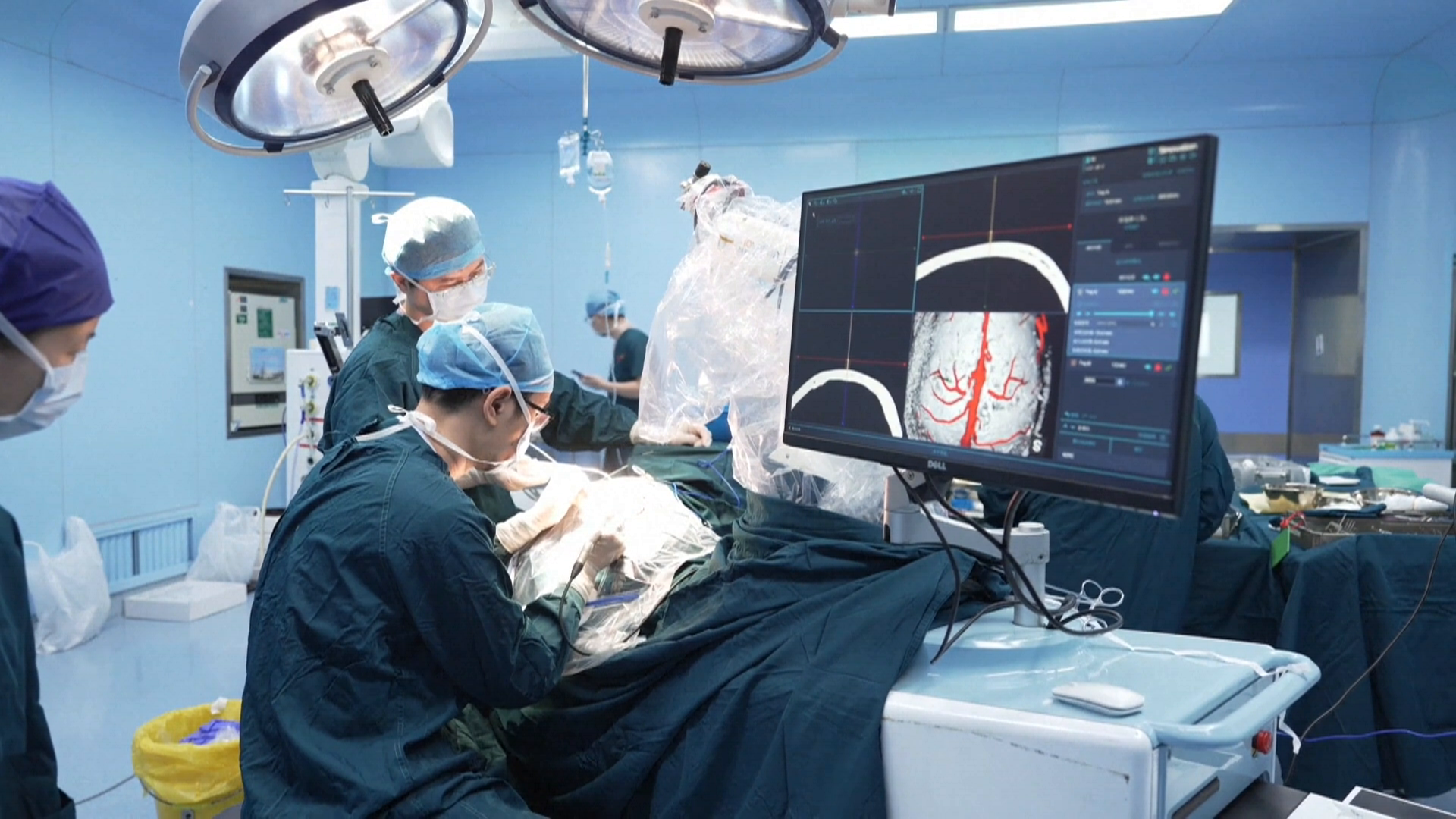 China: primera cirugía comercial cerebro‑computadora